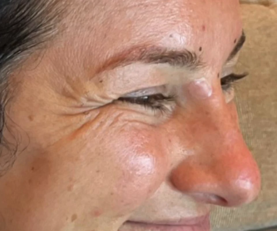 Before Dysport: deep crow's feet fanning from the outer corner of the eye while the guest smiles